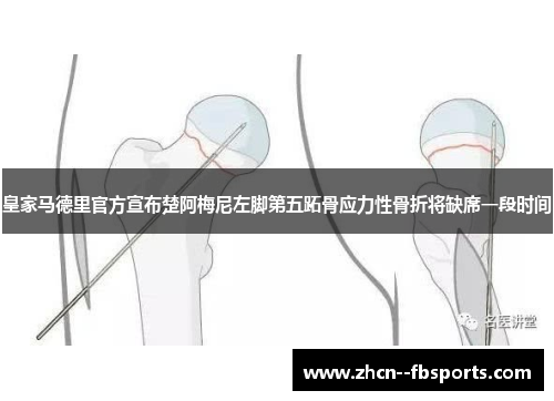 皇家马德里官方宣布楚阿梅尼左脚第五跖骨应力性骨折将缺席一段时间